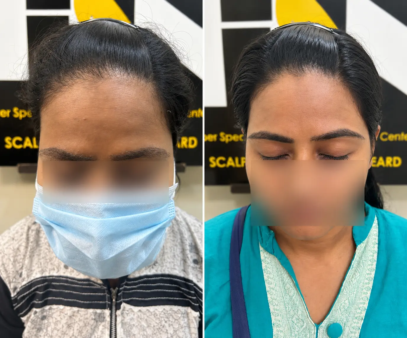 High-Density Eyebrow Restoration