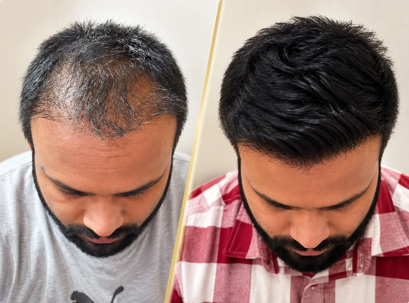 High-Density Hair Transplantation