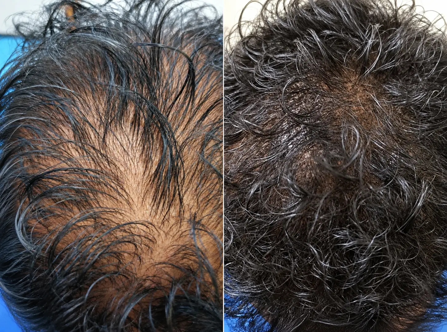 Scalp Micropigmentation (SMP)