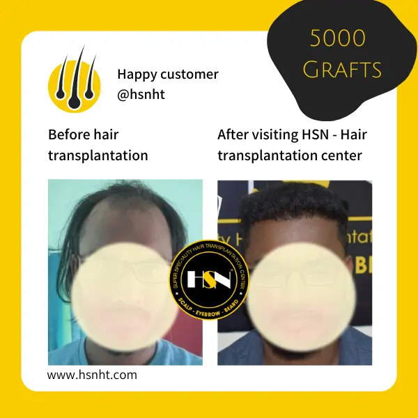 Receding Frontal Hairline Before & After