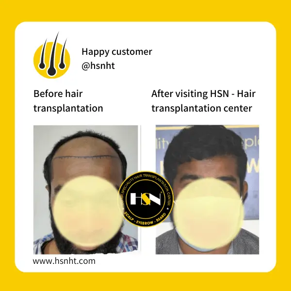Patchy Beard Before & After