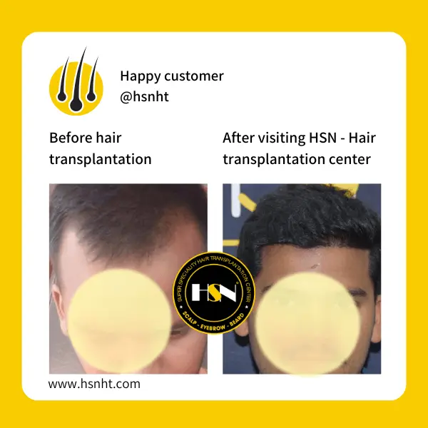 Beard Restoration Before & After