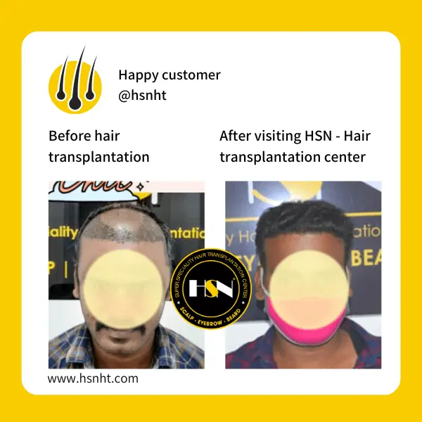 Hairline Correction Before & After