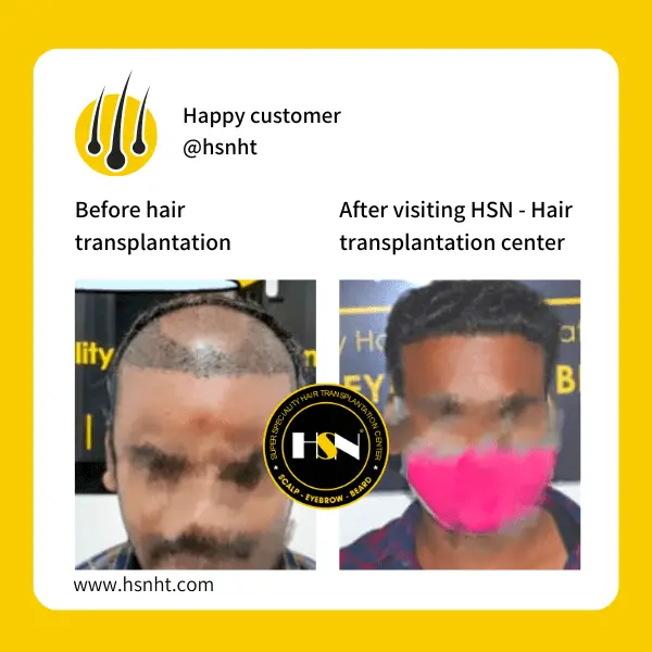 Beard Reconstruction Before & After