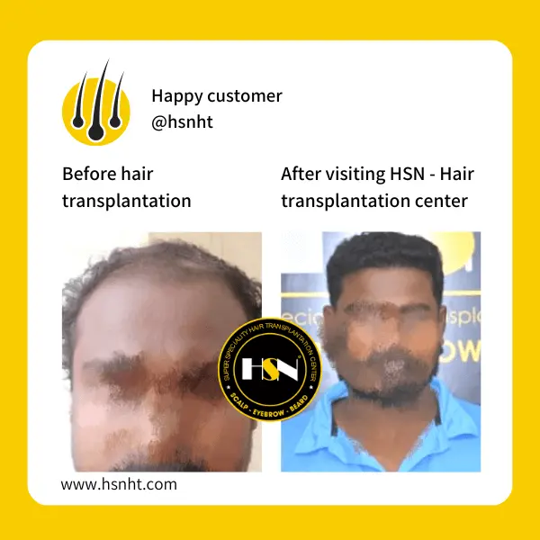 Hair Density Before & After