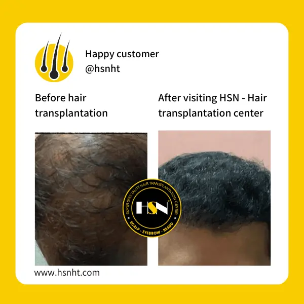 Hairline Density Before & After