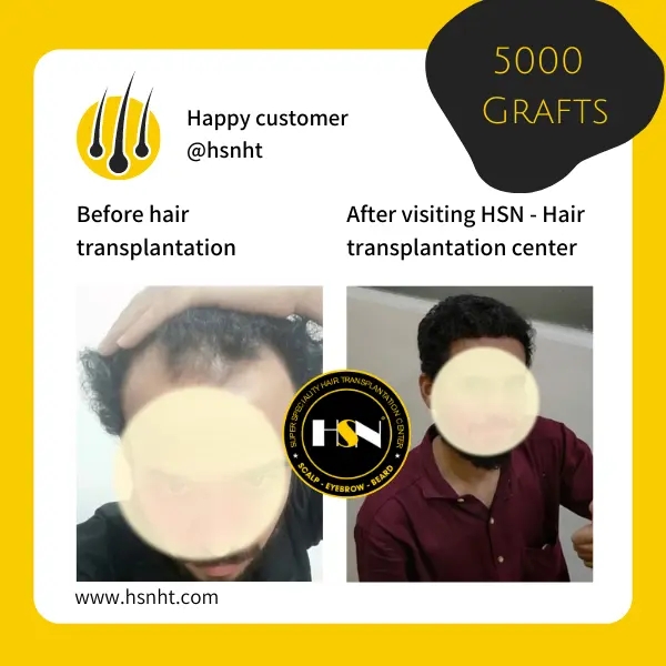 Hair Restoration Before & After